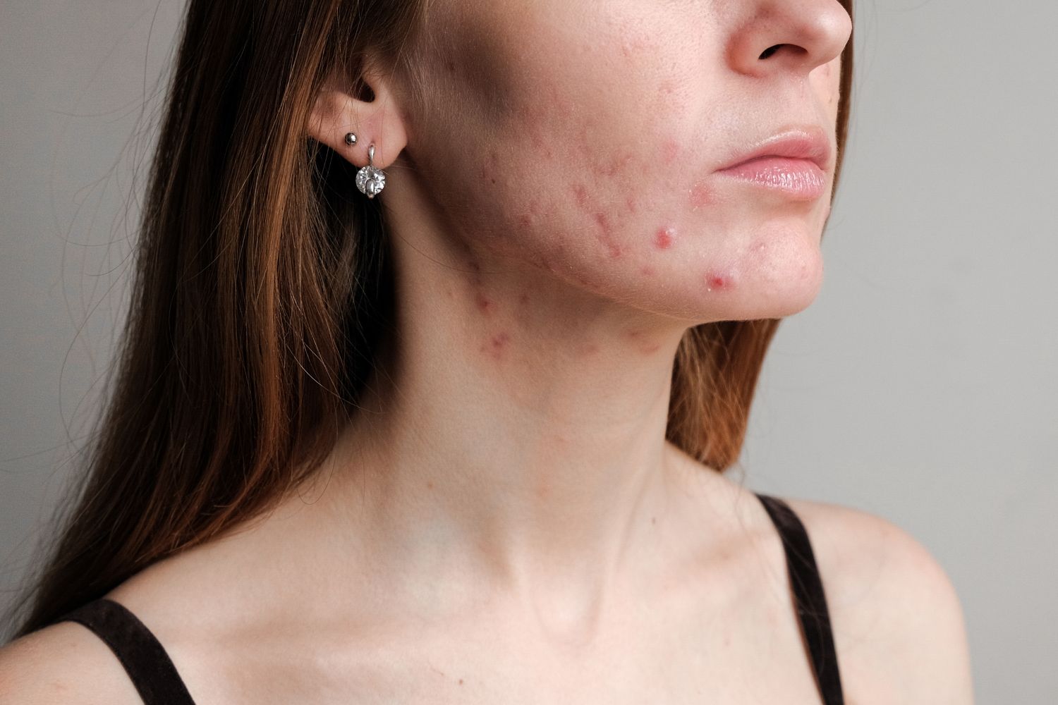 Conheça os tratamentos para cicatrizes da acne